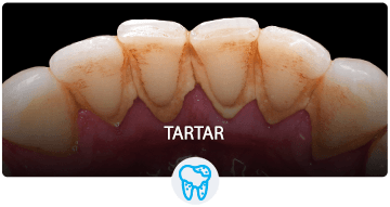 TARTAR
